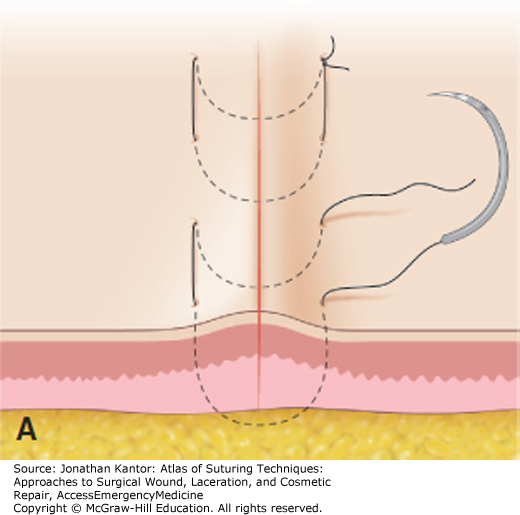 File:Horizontal Mattress sutures.png