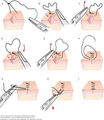 Running (continuous) sutures.png