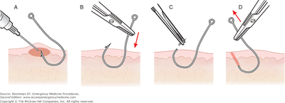 Push-through method.png