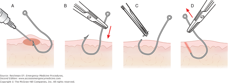 File:Push-through method.png