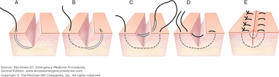 Vertical mattress sutures.png