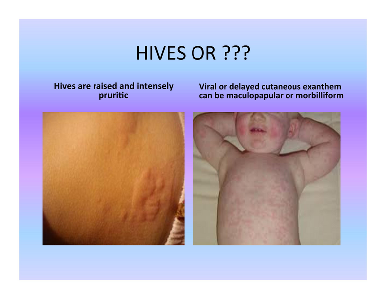 File:Stamping Out Amoxicillin Allergy.pdf