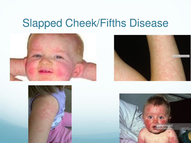 File:Childhood Rashes.pdf