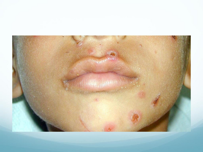 File:Childhood Rashes.pdf