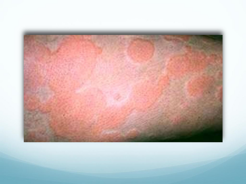 File:Childhood Rashes.pdf
