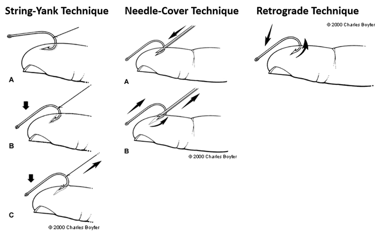 File:Fishhook removal.png