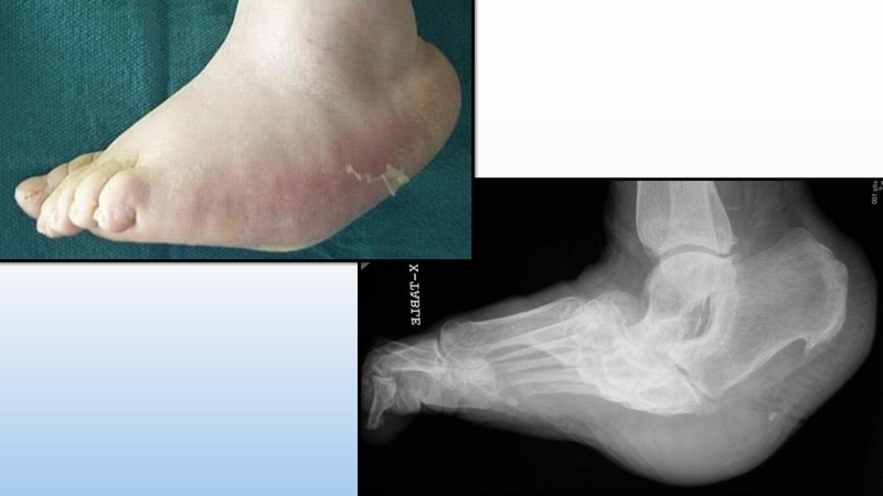 File:Diabetic Foot Complications 8.2017.pdf