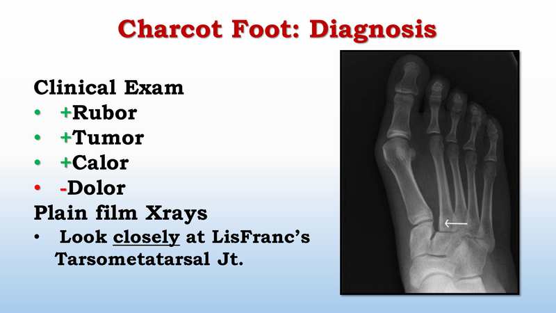 File:Diabetic Foot Complications 8.2017.pdf