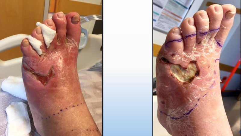 File:Diabetic Foot Complications 8.2017.pdf