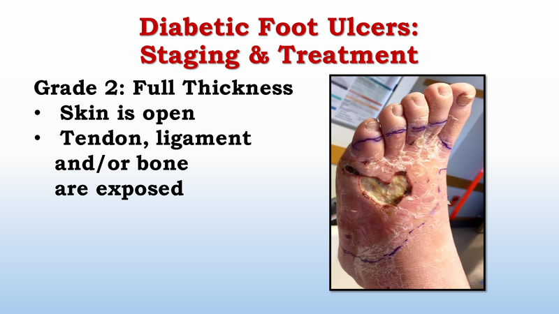 File:Diabetic Foot Complications 8.2017.pdf